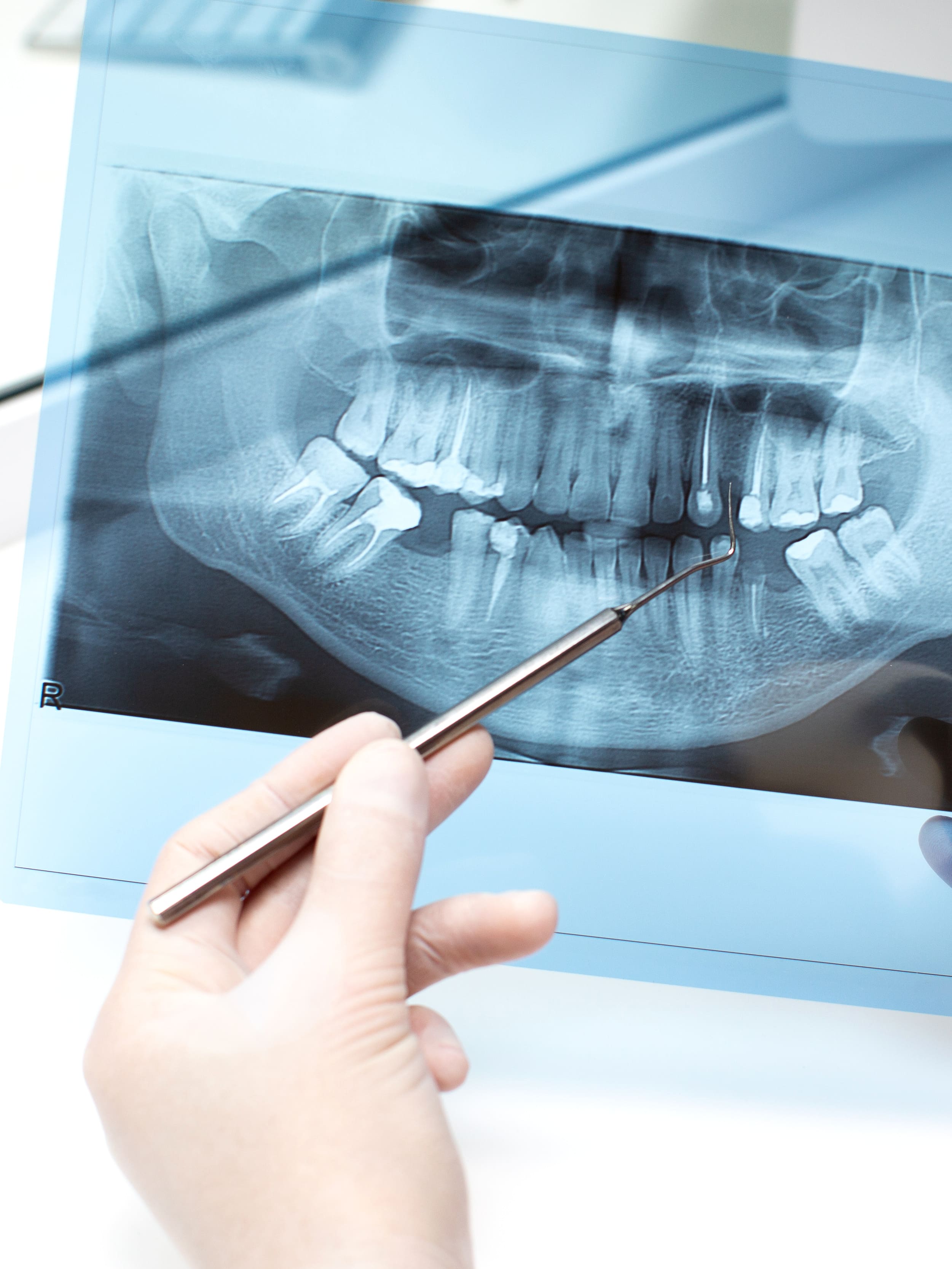 Tratamiento de Endodoncia