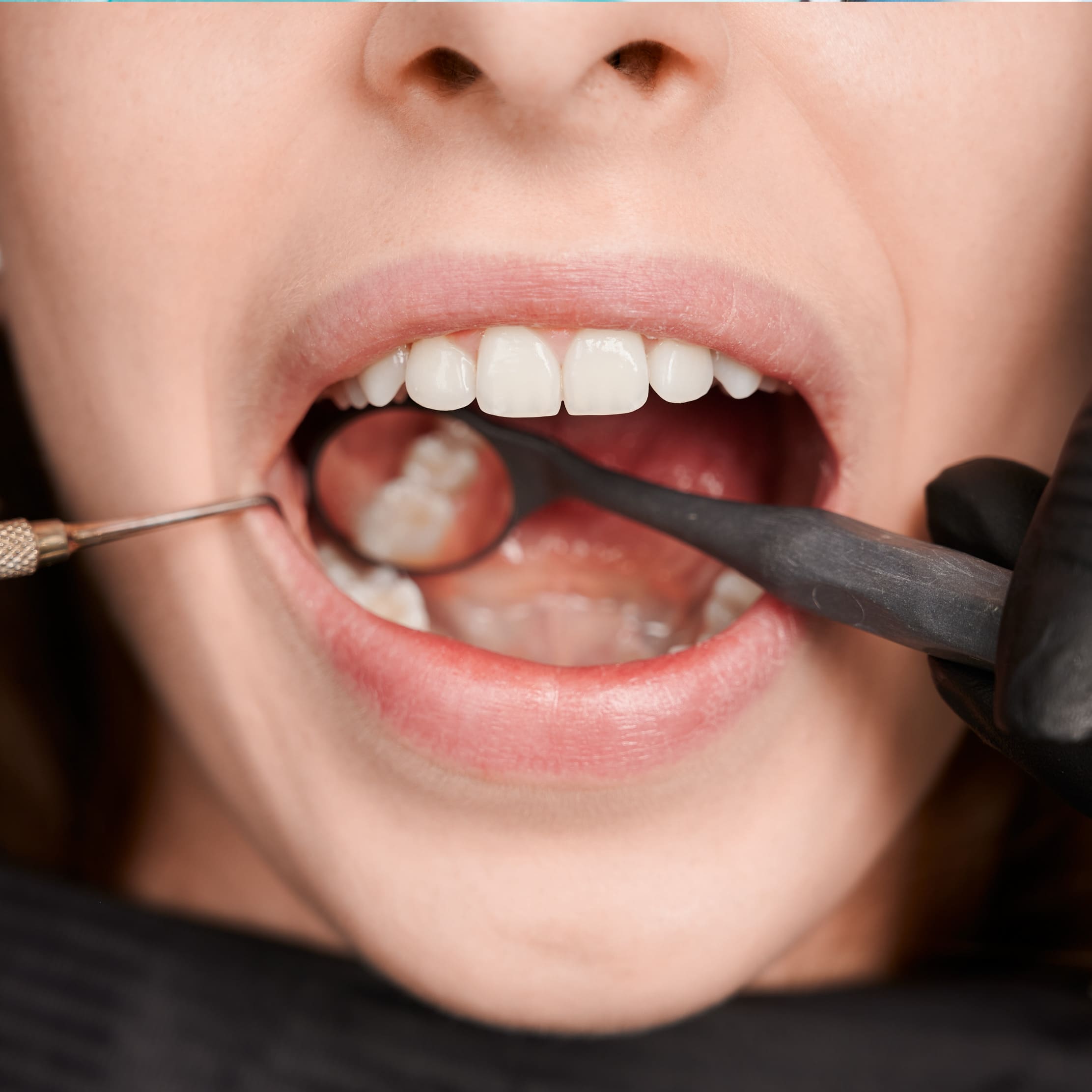Tratamiento de Periodoncia