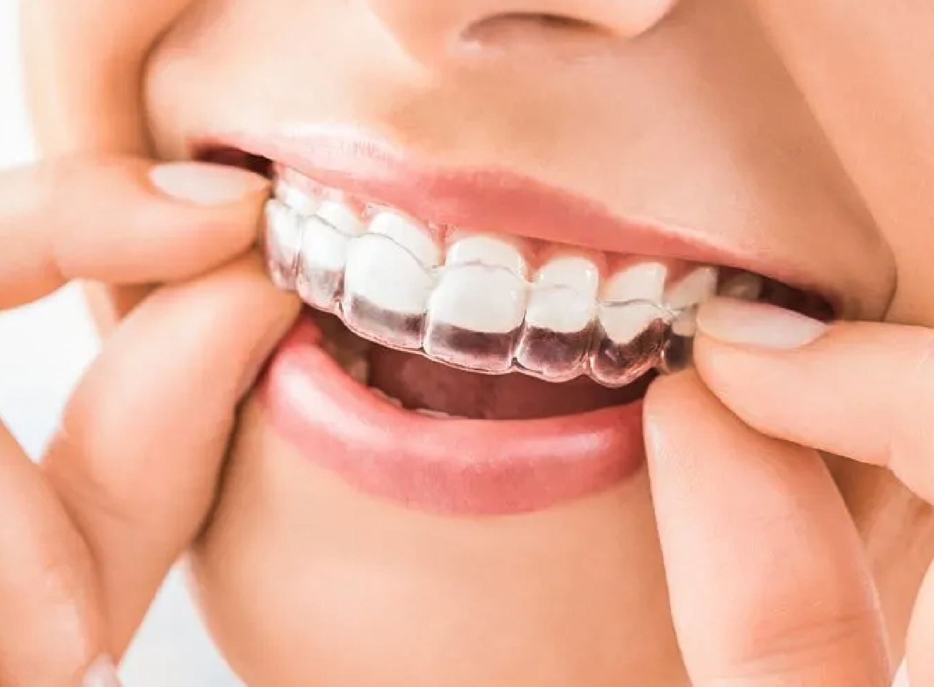 Alineadores Invisibles